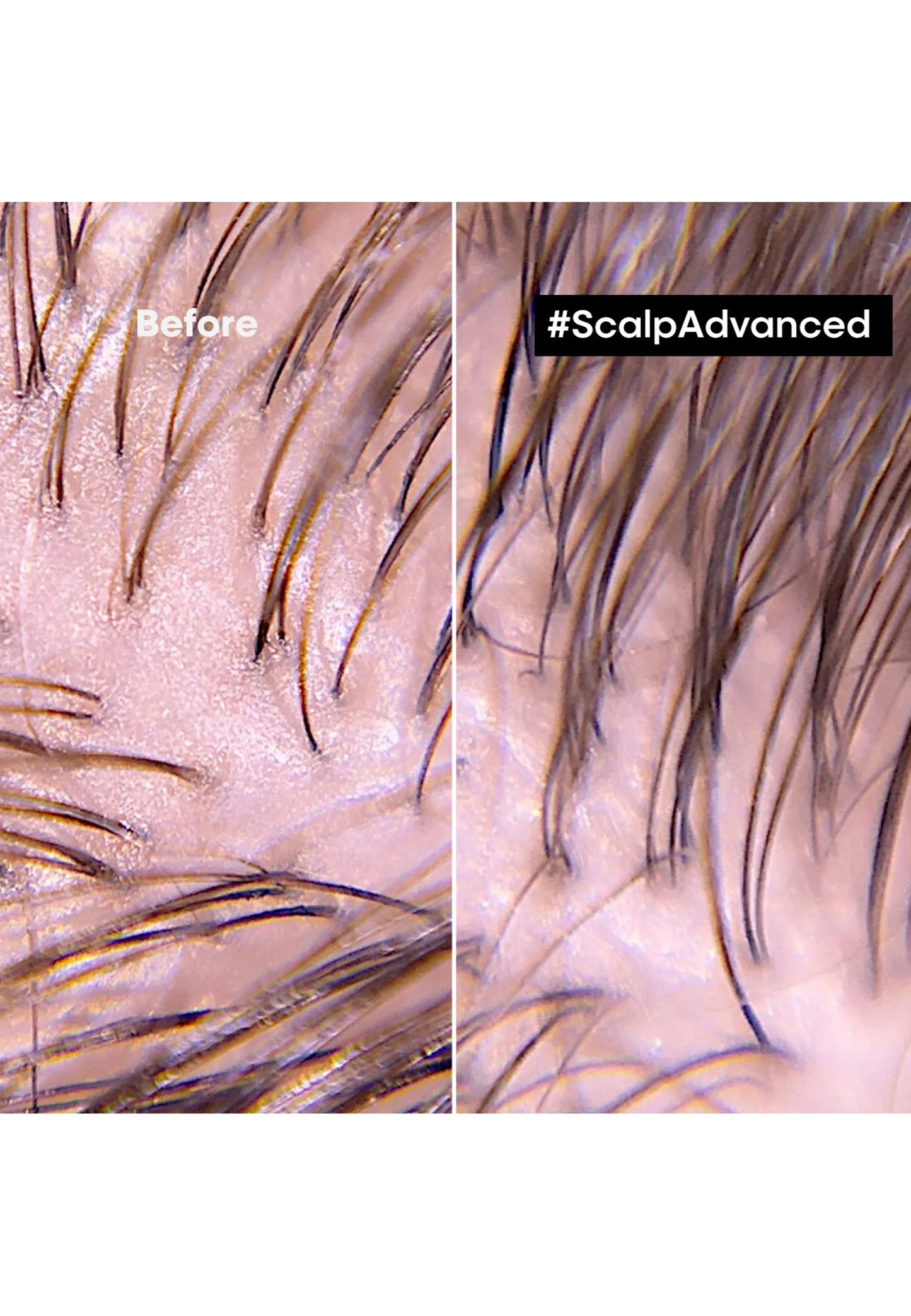L'Oreal Professionnel- Scalp Advanced Shampoo antiforfora