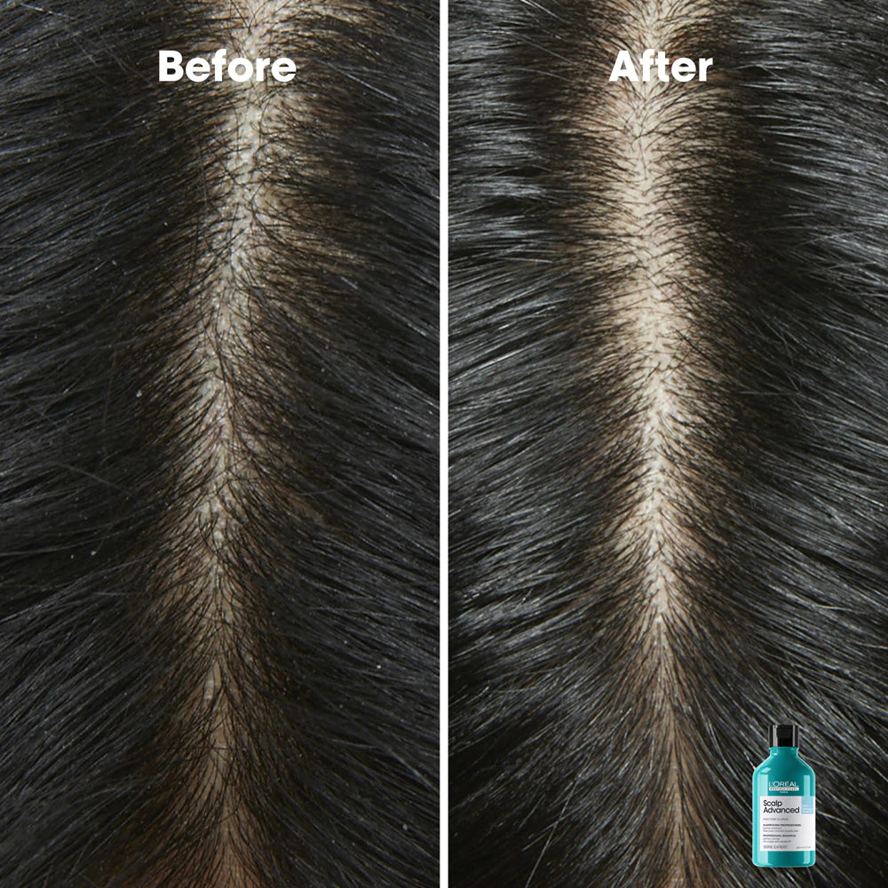 L'Oreal Professionnel- Scalp Advanced Shampoo antiforfora