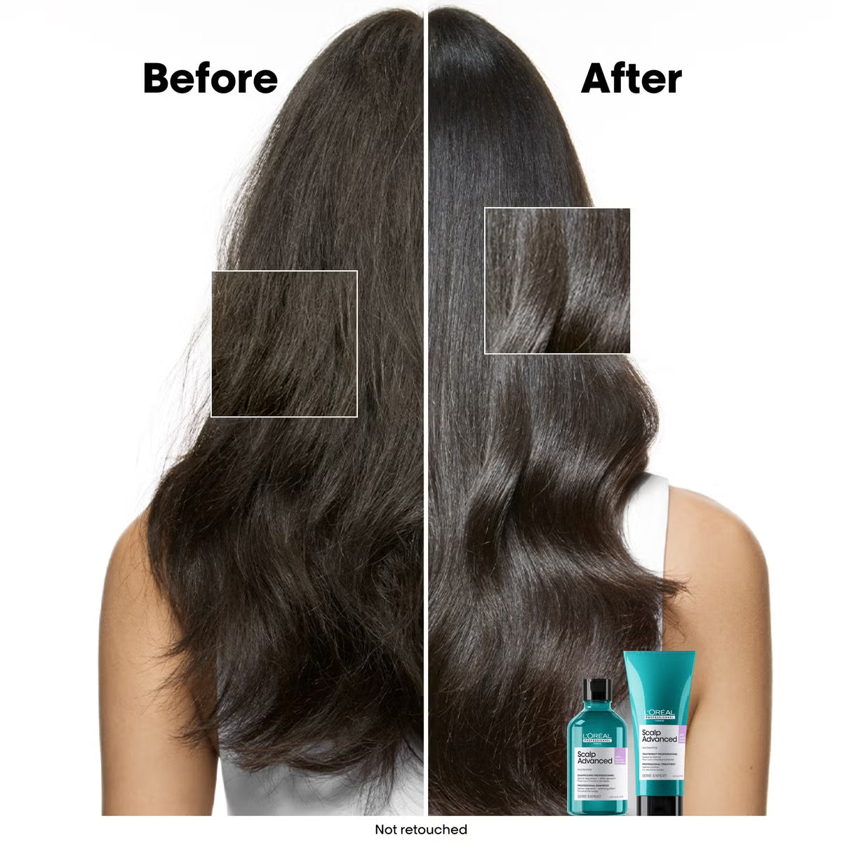 L'Oreal Professionnel- Scalp Advance Trattamento professionale